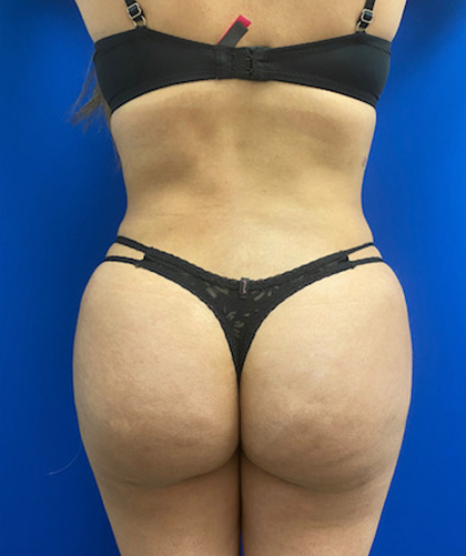 Brazilian Butt Lift case #3744