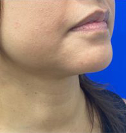 Neck Liposuction case #3924