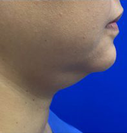 Neck Liposuction case #3924