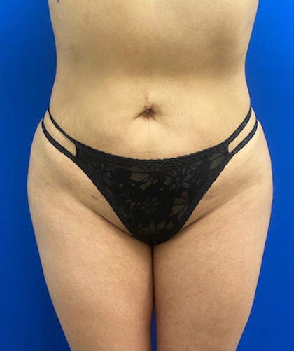 Brazilian Butt Lift case #3744