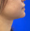 Neck Liposuction case #3924