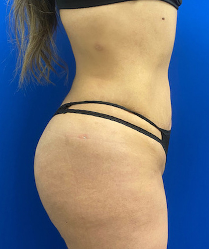 Brazilian Butt Lift case #3744