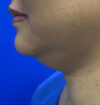 Neck Liposuction case #3924