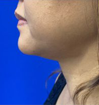 Neck Liposuction case #3924