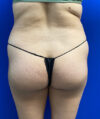 Brazilian Butt Lift case #3755