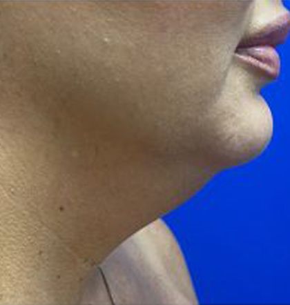 Neck Liposuction case #3933