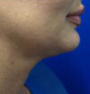 Neck Liposuction case #3933