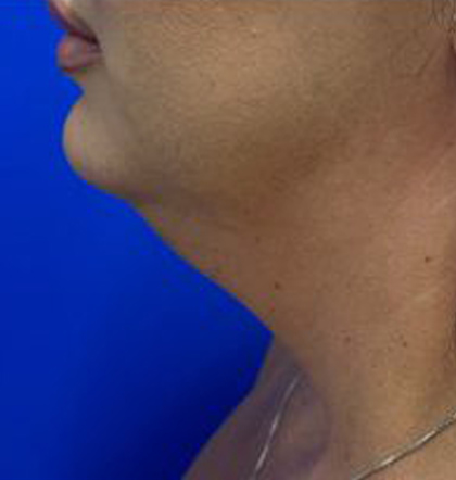 Neck Liposuction case #3933