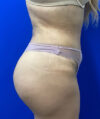 Brazilian Butt Lift case #3755