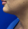 Neck Liposuction case #3933