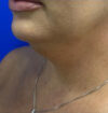 Neck Liposuction case #3933