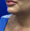 Neck Liposuction case #3933