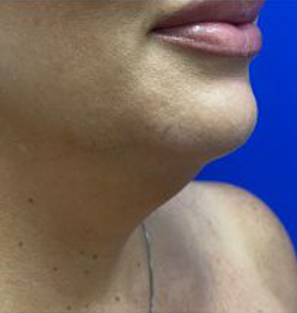 Neck Liposuction case #3933