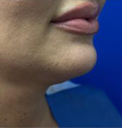 Neck Liposuction case #3933