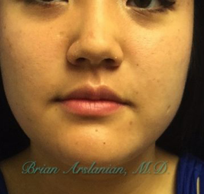 | Arslanian Plastic Surgery Atlanta Before & After Plastic Surgery Results | facial procedure