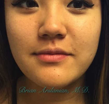 | Arslanian Plastic Surgery Atlanta Before & After Plastic Surgery Results | facial procedure