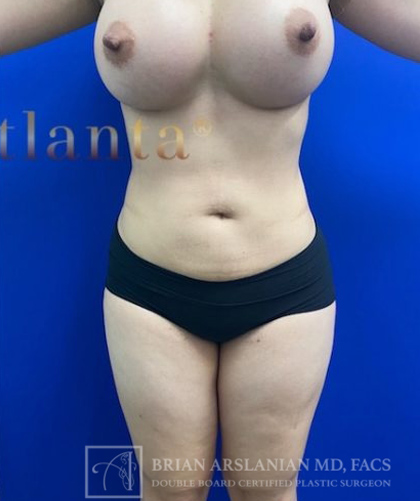 Liposuction case #3763