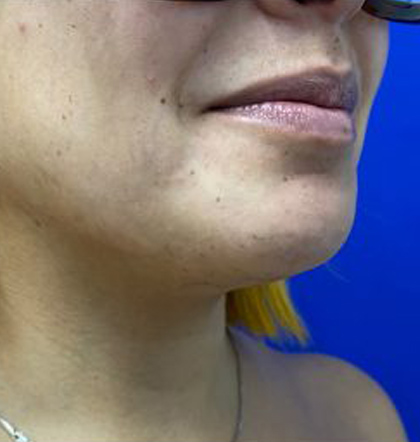 Neck Liposuction case #3943