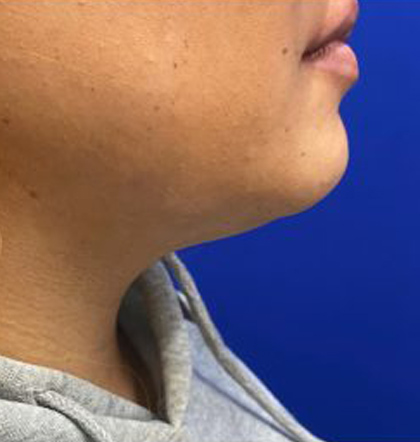 Neck Liposuction case #3943