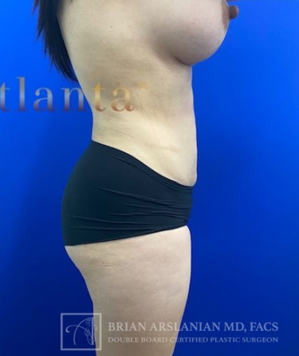 Liposuction case #3763