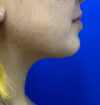 Neck Liposuction case #3943