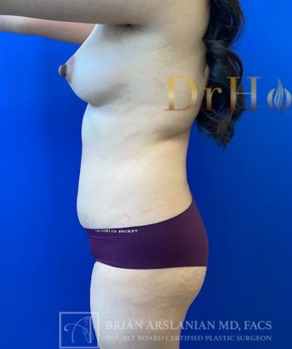 Liposuction case #3763