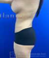 Liposuction case #3763