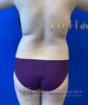 Liposuction case #3763