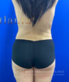 Liposuction case #3763