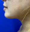 Neck Liposuction case #3943