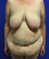 Tummy Tuck case #3953