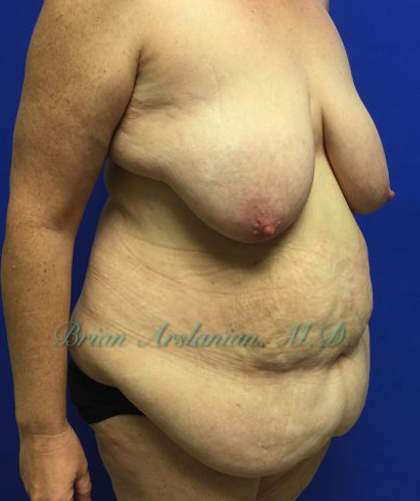 Tummy Tuck case #3953