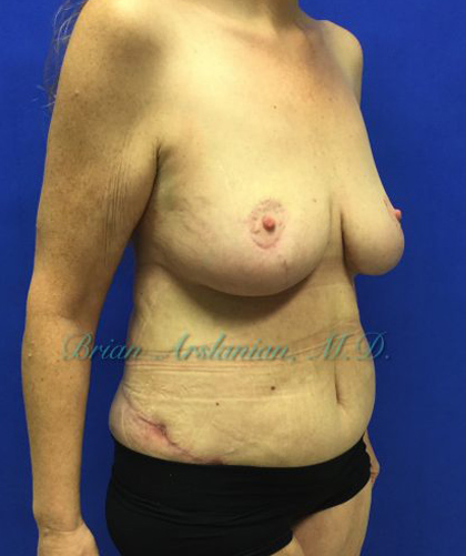 Tummy Tuck case #3953