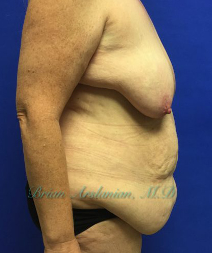 Tummy Tuck case #3953