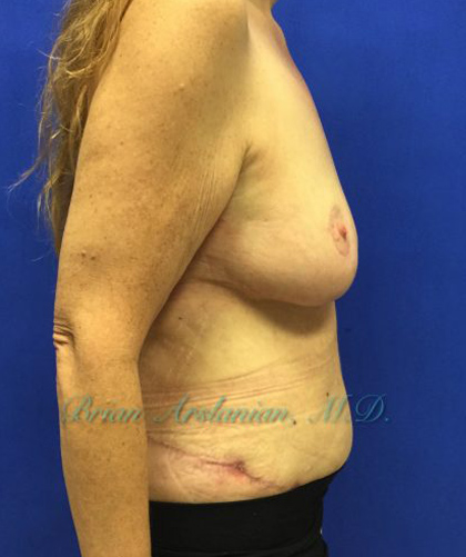 Tummy Tuck case #3953