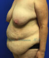 Tummy Tuck case #3953