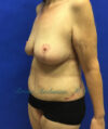 Tummy Tuck case #3953