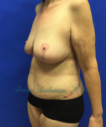 Tummy Tuck case #3953