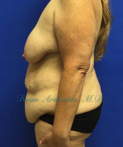 Tummy Tuck case #3953