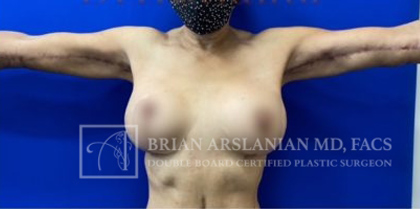 Liposuction case #3772