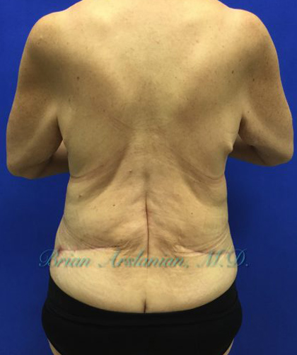 Tummy Tuck case #3953