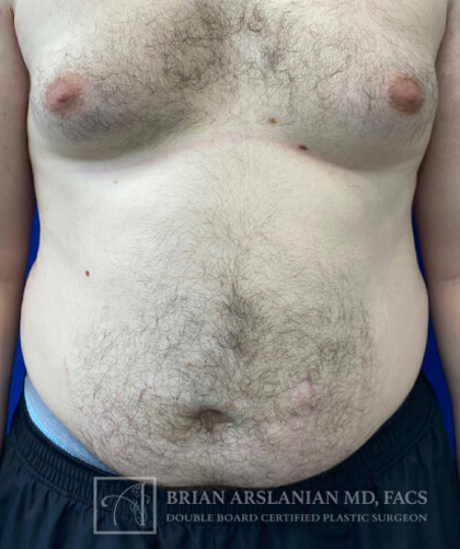 Liposuction case #3785