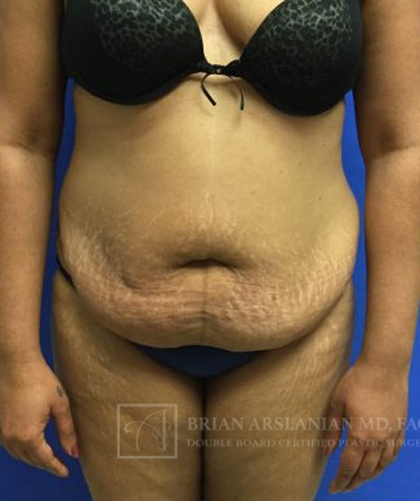 Tummy Tuck case #3968