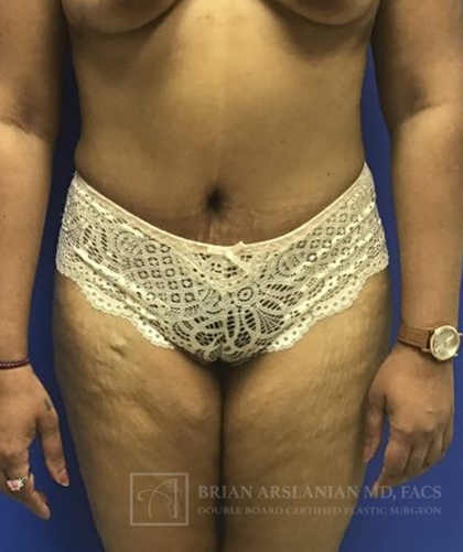| Arslanian Plastic Surgery Atlanta Before & After Plastic Surgery Results | body procedure