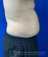 Liposuction case #3785