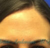 Botox® case #2414