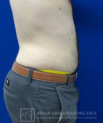 Liposuction case #3785