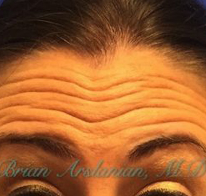 Botox® case #2414