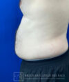 Liposuction case #3785