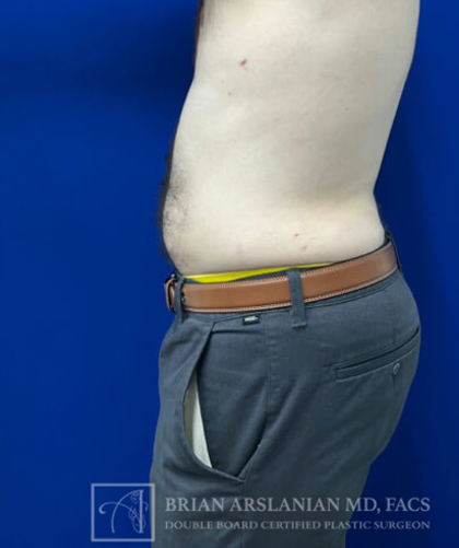 Liposuction case #3785